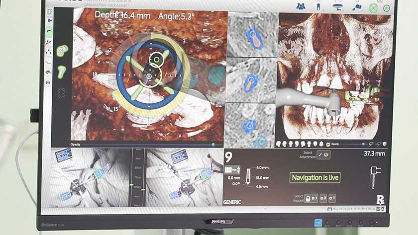Hệ thống camera giúp bác sĩ quan sát mũi khoan rõ hơn